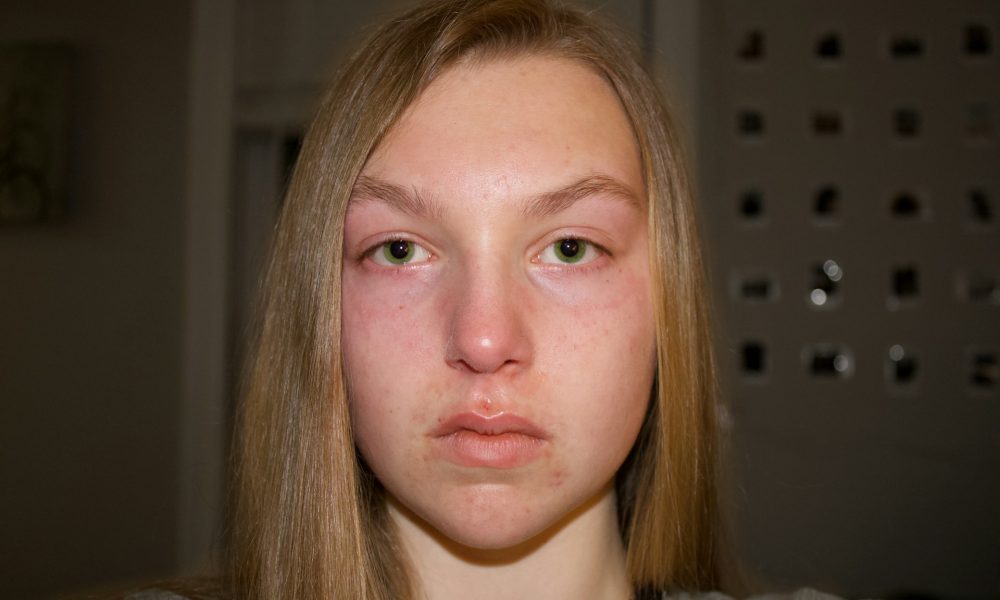 Лицо отекшее