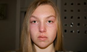 Лицо отекшее