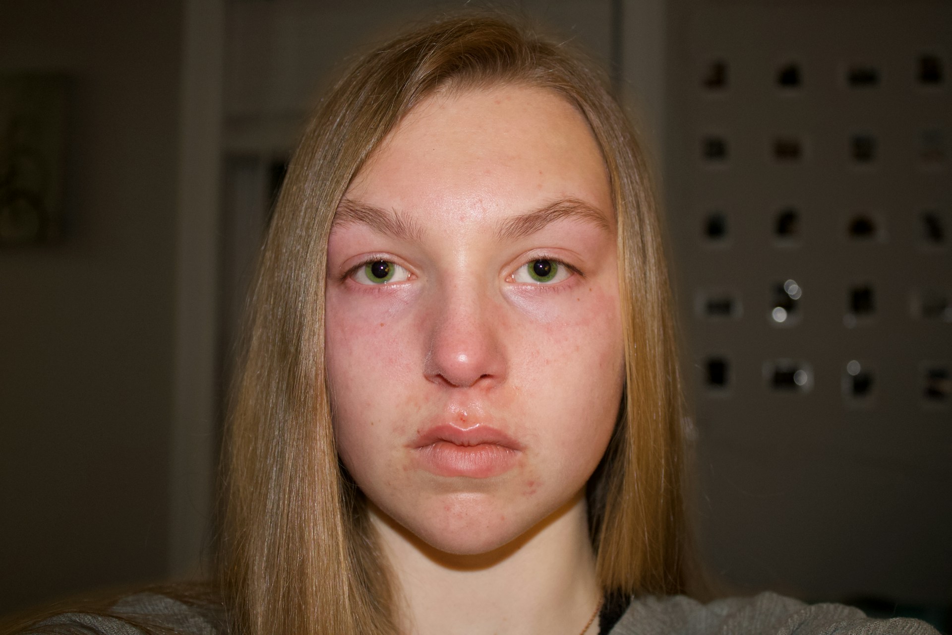 Лицо отекшее