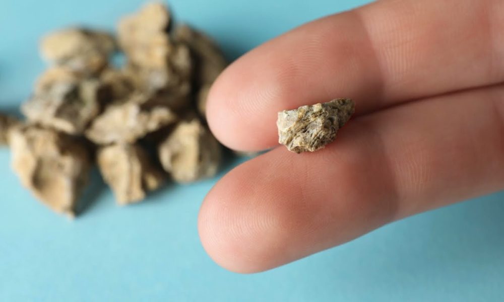 Камни в почках