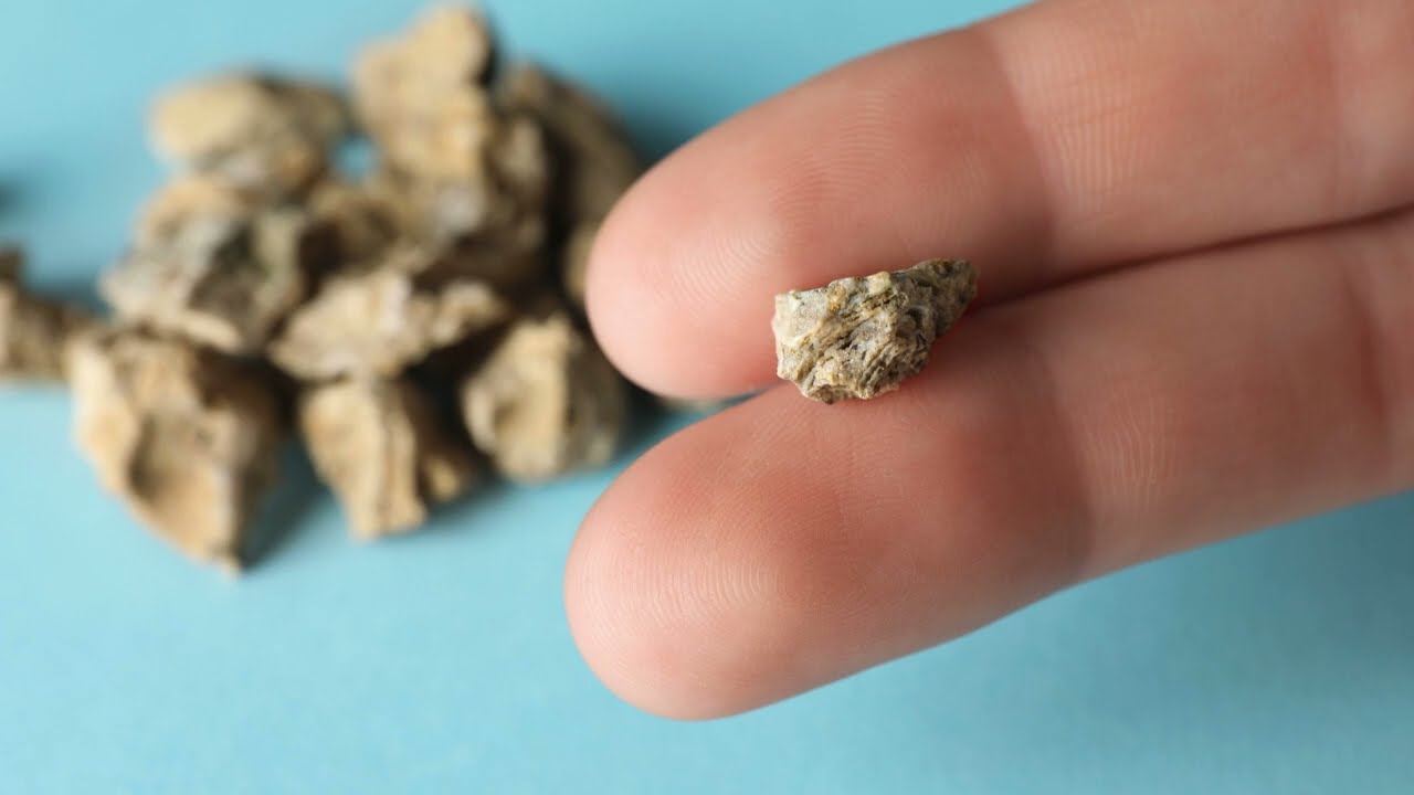 Камни в почках