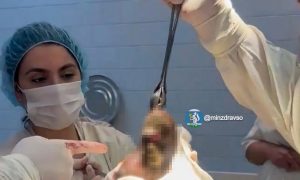 Удаленные из желудка свердловчанки волосы